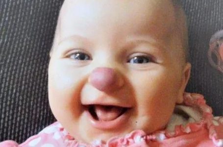 Il y a 9 ans, cet adorable bébé est né avec un “nez de clown”. Comment vit-elle maintenant et à quoi ressemble-t-elle