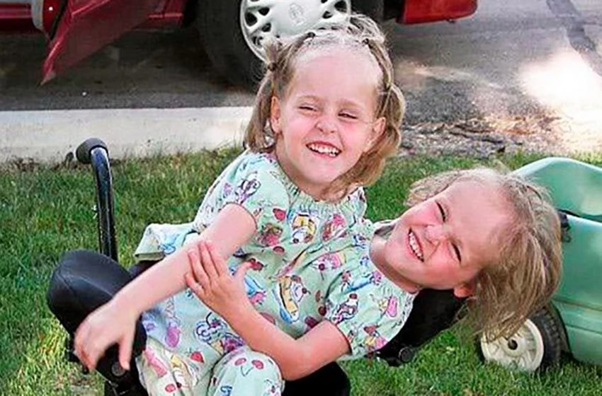 Les jumeaux siamois ont été séparés lorsqu’ils avaient quatre ans: les filles ont maintenant 18 ans