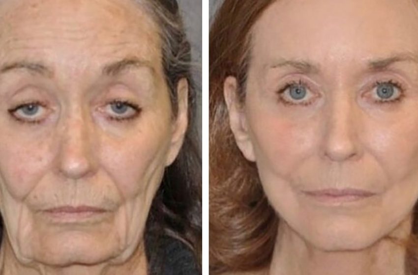  La vieillesse a été retardée: les femmes à l’âge de la retraite avant et après la chirurgie plastique faciale
