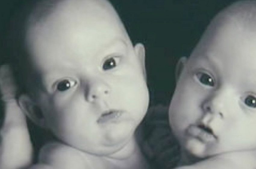  Des jumelles siamoises ont été séparées par des chirurgiens il y a 14 ans. Comment vivent-elles maintenant