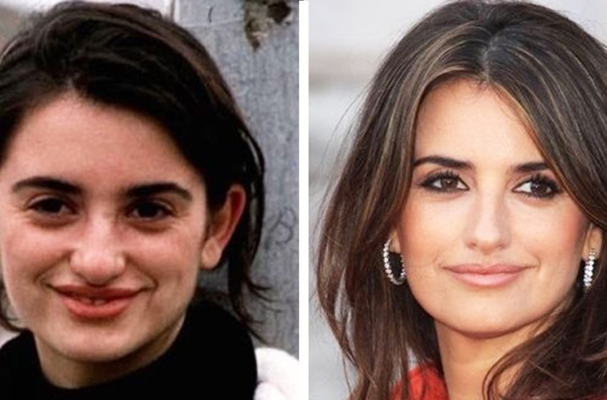  L’âge ou la rhinoplastie : voici des célébrités qui sont devenues beaucoup plus séduisantes après une opération du nez