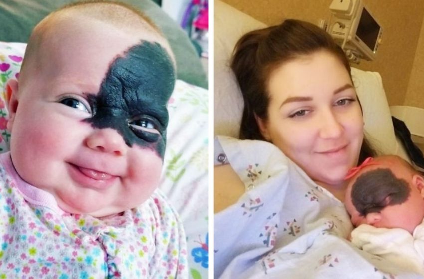  La “baby Batman” américaine, née avec une tache de naissance sur le visage, comment se présente-t-elle aujourd’hui ?