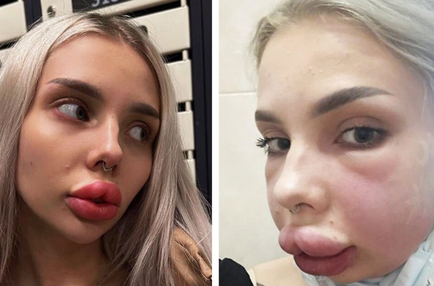  Lèvres à mi-chemin de son visage : une jeune femme a failli mourir après une procédure esthétique