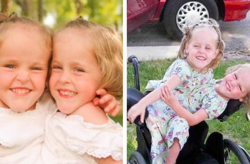  Ces jumelles siamoises ont été séparées à l’âge de 4 ans, elles ont maintenant 18 ans. Comment vivent-elles aujourd’hui?