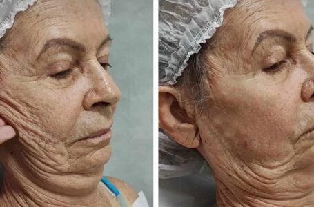 “Hän on tunnistamaton plastiikkakirurgian jälkeen”: Vanha nainen muuttui nuoreksi kaunottareksi!