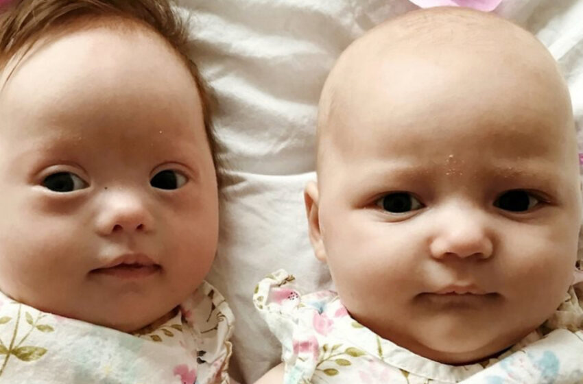  Kaksoset, joiden todennäköisyys on yksi miljoonasta: Toinen sairastaa Downin syndroomaa, toinen ei!