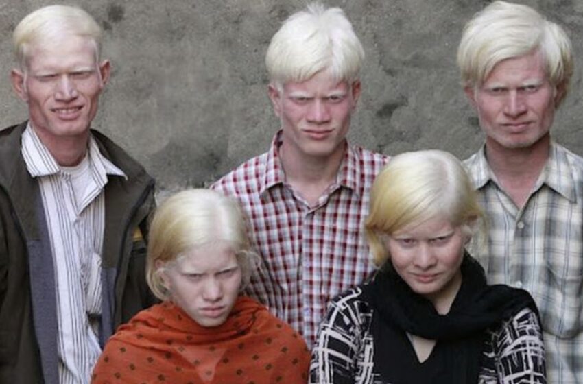  Maailman Suurin Albino-perhe Valloittaa Huomiota!: Katso Lisää Kuvia